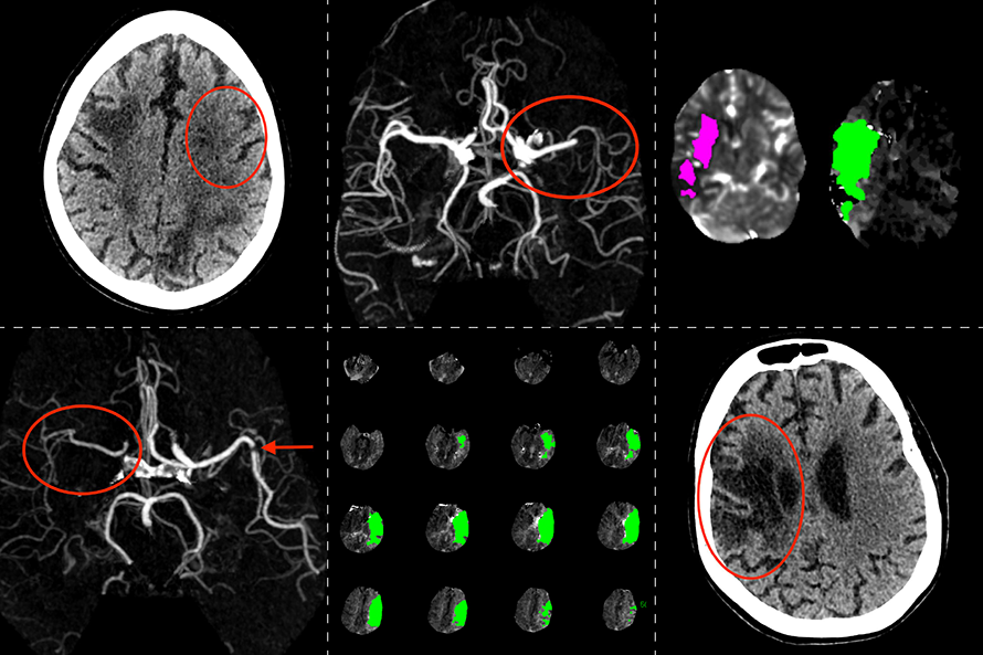 Brain imaging scans including non contrast CT head, CT Angiograms and advanced CTP